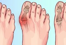 මහපට ඇඟිල්ලේ ඉදිමීම නිසා ඇතිවන වේදනාව පැය 24න් සුව කරගන්න ක්රම 8 ක්