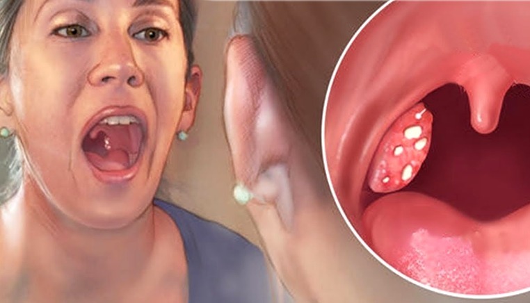 සෙම් ගෙඩි පැය 4න් සනීප කරන විශ්මිත බෙහෙත් පානය මෙන්න.