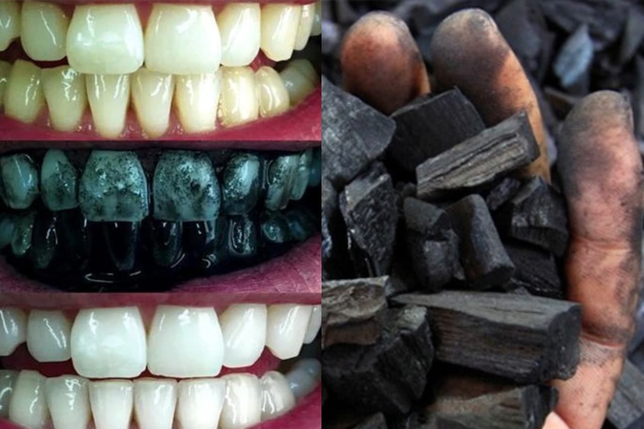 කහ ගැහැනු දත් සුදු කරගන්න මෙන්න ක්රමේ – අඟුරු ගැන ඔබ නොදන්නා ඉතා වටිනා කරුණු රැසක්..