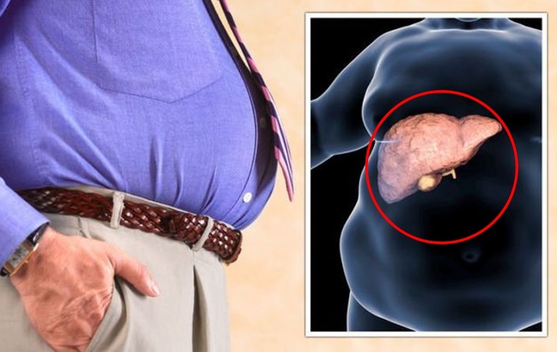 අක්මාවේ මේදය තැන්පත්වීම වළකන දිව ඔසු.