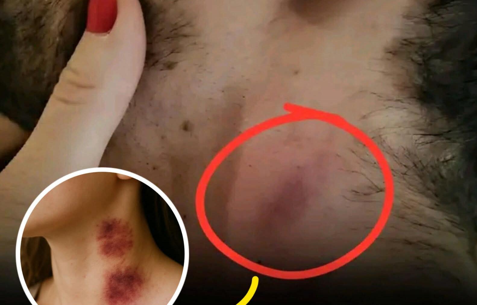 ඔහු හදිසියේම සිහිසුන්ව ඇද වැටුණා.. “Love Bite” එකක් තරුණයෙකුගේ ජීවිතයක් උදුරාගනී..