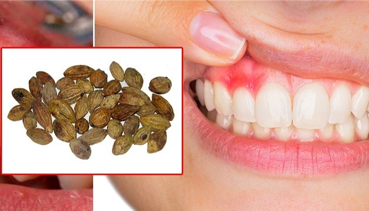 දත්මුල් දියවීම ඇතුළු ඔබේ දත් දෙපල ආරක්ෂා කරගන්න කැමතිද ? එහෙනම් මේක දිව්යමය ඖෂධයක් වේවී…