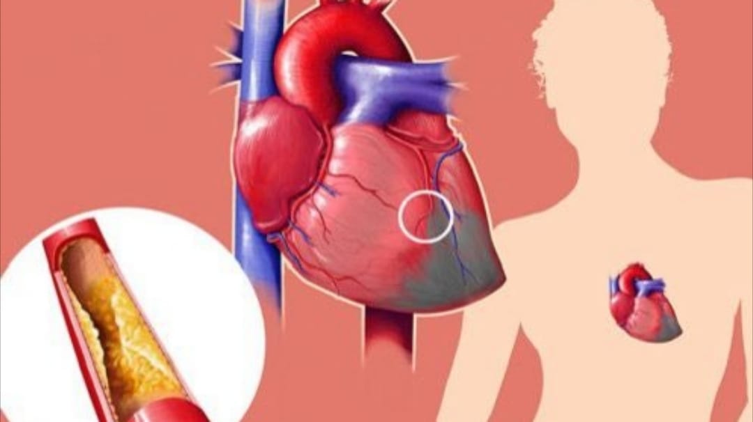 කොලෙස්ටරෝල් මට්ටු කරන කෙට්ටු වෙන්න කැමති අයට බොන්න මේ විශ්මිත පානය ගෙදරදීම හදලා බලන්න…